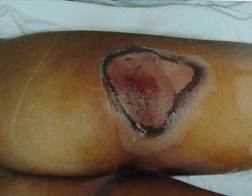 Photo of a human leg damaged by radiation in later stages