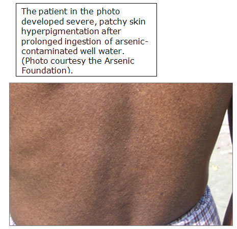 severe, patchy skin hyperpigmentation