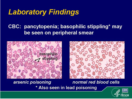 basophilic stippling as seen on a smear