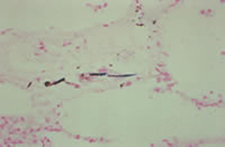 Figure 4. Asbestos fiber retained in lung tissue