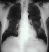 Pleural Plaques