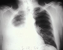 Pleural Mesothelioma