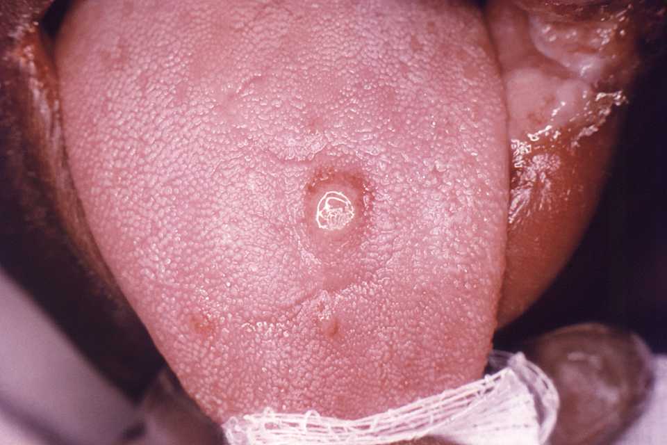 Primary stage syphilis sore (chancre) on the surface of a tongue.