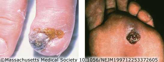 Bacillary angiomatosis