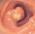 Photo of Polyp