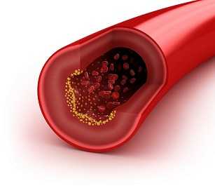 Image of an artery with cholesterol build up.