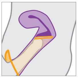 Female condom in place with penis inserted into vagina.