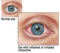 Image of pinkeye