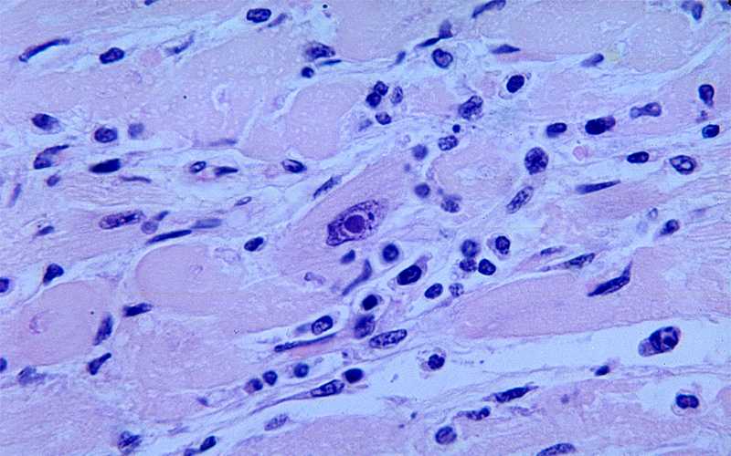 Micrograph revealing an intranuclear inclusion body in a heart section from a patient with diphtheria-related myocarditis