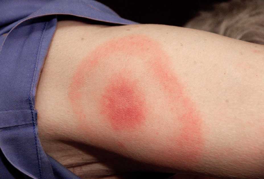 Bull’s-eye Rash