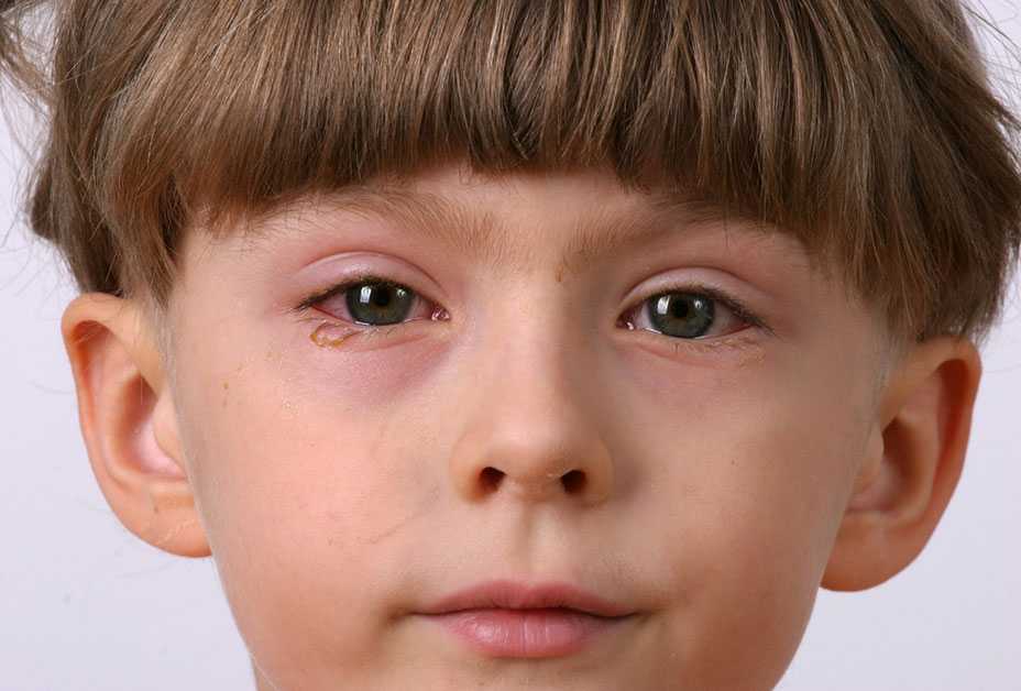 Boy with pink eye