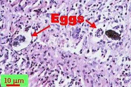 Angiostrongylus costaricensis eggs and larvae in tissue stained with hematoxylin and eosin (H&E).