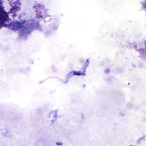 	Trypanosomiasis, African