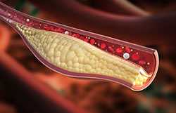 Illustration of cholesterol and arteries