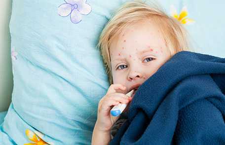 Young girl with chickenpox