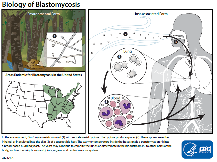 In the environment, Blastomyces dermatitidis exists as mold (1) with septate aerial hyphae. The hyphae produce conidial spores (2). These spores are either inhaled, or inoculated into the skin (3) of a susceptible host. The warmer temperature inside the host signals a transformation (4) into a broad-based budding yeast. The yeast may continue to colonize the lungs or disseminate in the bloodstream (5) to other parts of the body, such as the skin, bones and joints, organs, and central nervous system.