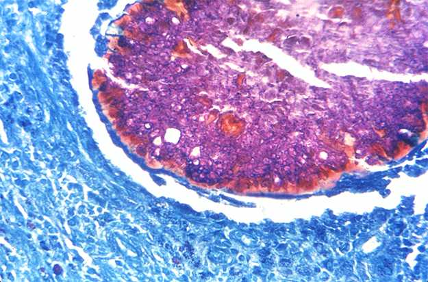 PAS-stained photomicrograph revealing the presence of the fungal organism Madurella mycetomatis in the form of vesicular granules.