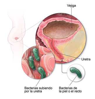 Diagrama del aparato urinario que muestra cómo las bacterias pueden causar una infección.