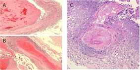 A collage of microscopic views of tissues showing evidence of necrotizing or involving a branch of the basilar artery.