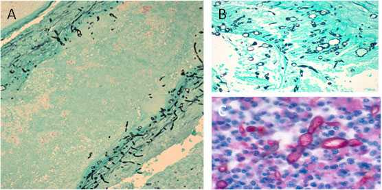 A collage of microscopic views of tissues showing various ways to visualize fungal hyphae.