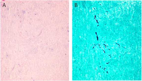 Microscopic views of tissues surrounding the spinal cord comparing the visibility of Arachnoiditis.