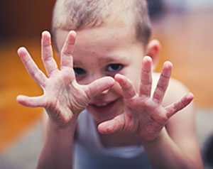 Boy with symptoms hand, foot and mouth disease.