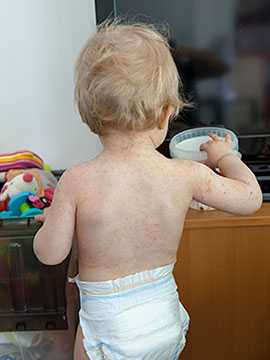 Toddler with hand , foot and mouth disease.