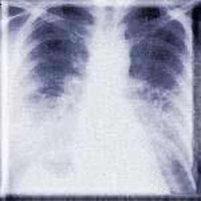 x-ray view mitral stenosis causing interstitial edema with a normal-sized cardiac silhouette