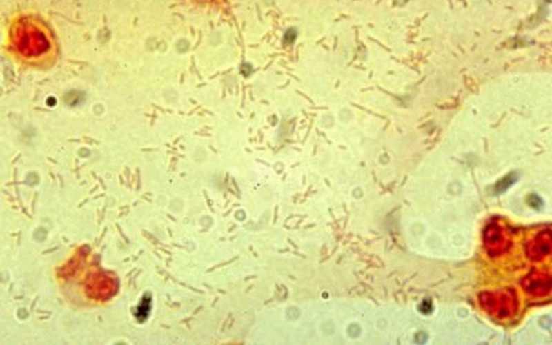 Cerebrospinal fluid culture positive for Haemophilus influenzae, type b (Gram stain).