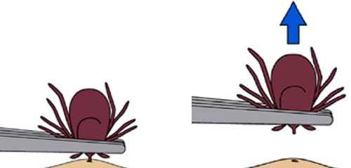 	clipart style image showing the proper removal of a tick using a pair of tweezers