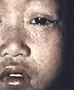 Young, dark-skinned child with watery eyes, runny nose, and raised rash.