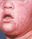 Face of boy with measles, (third day rash).