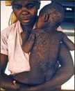 This late 1960s photograph shows a Nigerian mother and her child who was recovering from measles; note that the skin is sloughing on the child as he heals from his measles infection.