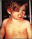 This child shows a classic day-4 rash with measles.