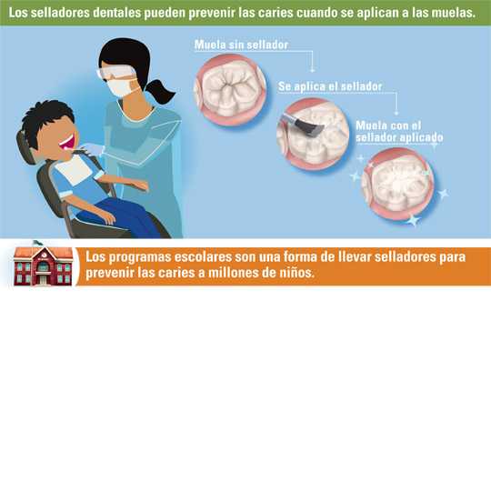 Los selladores dentales previenen las caries