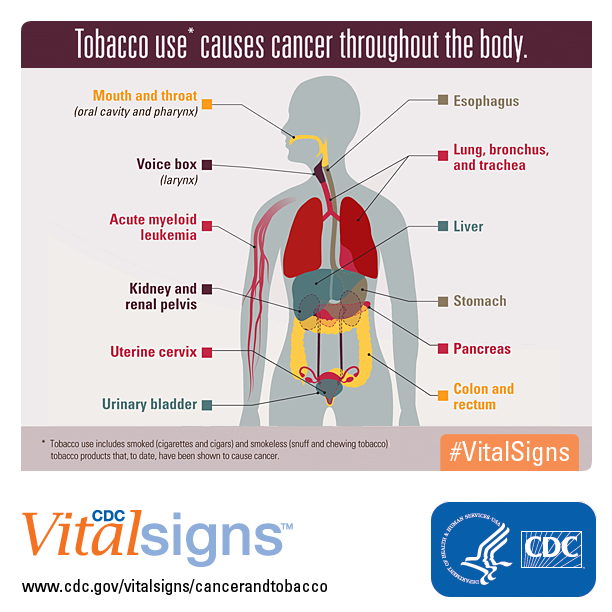 Infographic: Tobacco use* causes cancer throughout the body