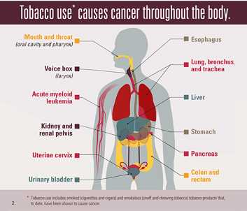 Infographic: Tobacco use* causes cancer throughout the body