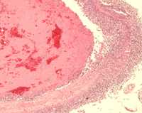 Microscopic examination of tissue from meningitis patients