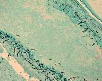 Microscopic examination of tissue from meningitis patients