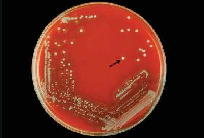 Figure 16 is a picture showing the small grey, flat colonies surrounded by a greenish zone of alpha-hemolysis are S. pneumoniae and the white colonies with no hemolytic action are S. aureus.