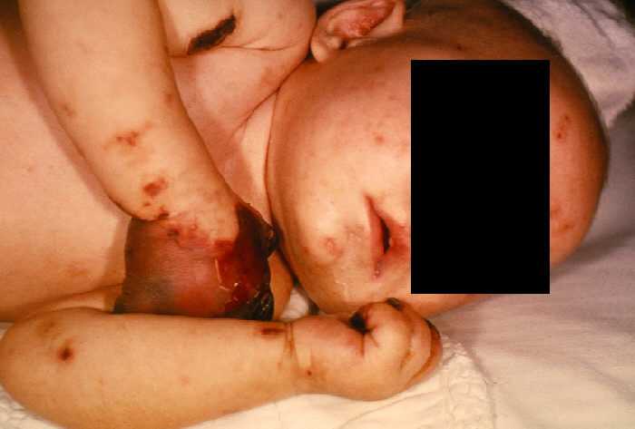 4 month old female with gangrene of hands due to 4 month old female with gangrene of hands due to meningococcemia