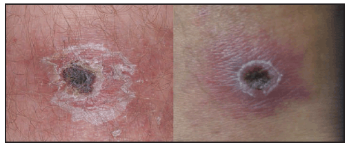 This figure is a photograph showing various appearances of eschars associated with Rickettsia parkeri rickettsiosis.