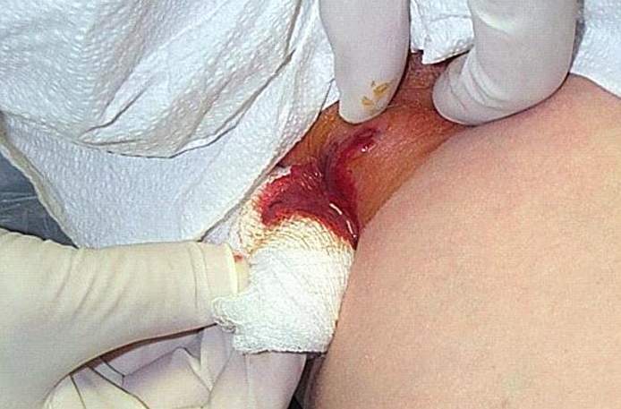 Photograph depicted a cutaneous abscess,  caused by MRSA