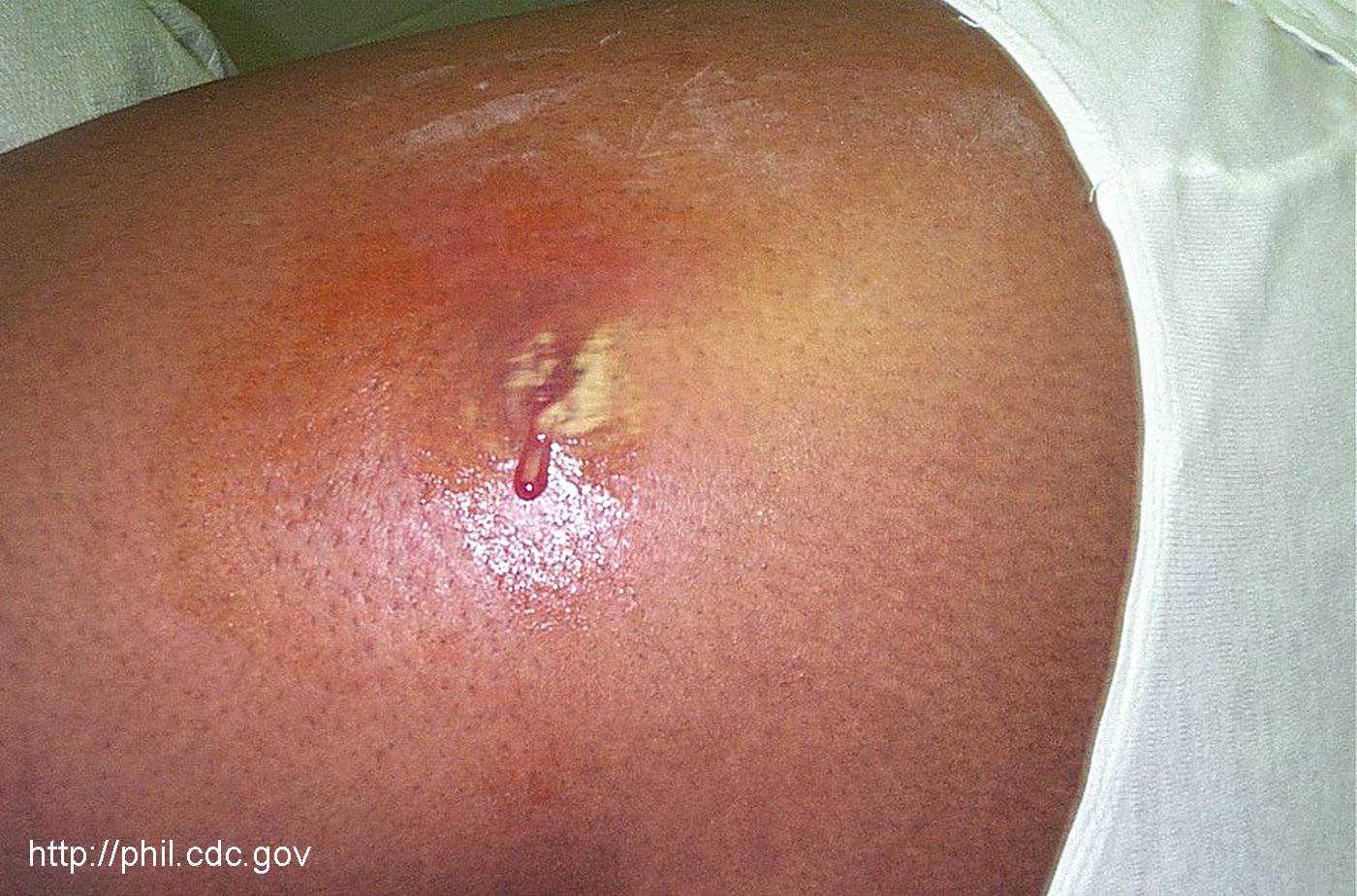 Cutaneous abscess caused by MRSA