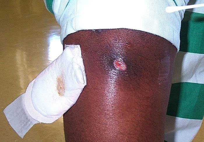 Cutaneous abscess on leg