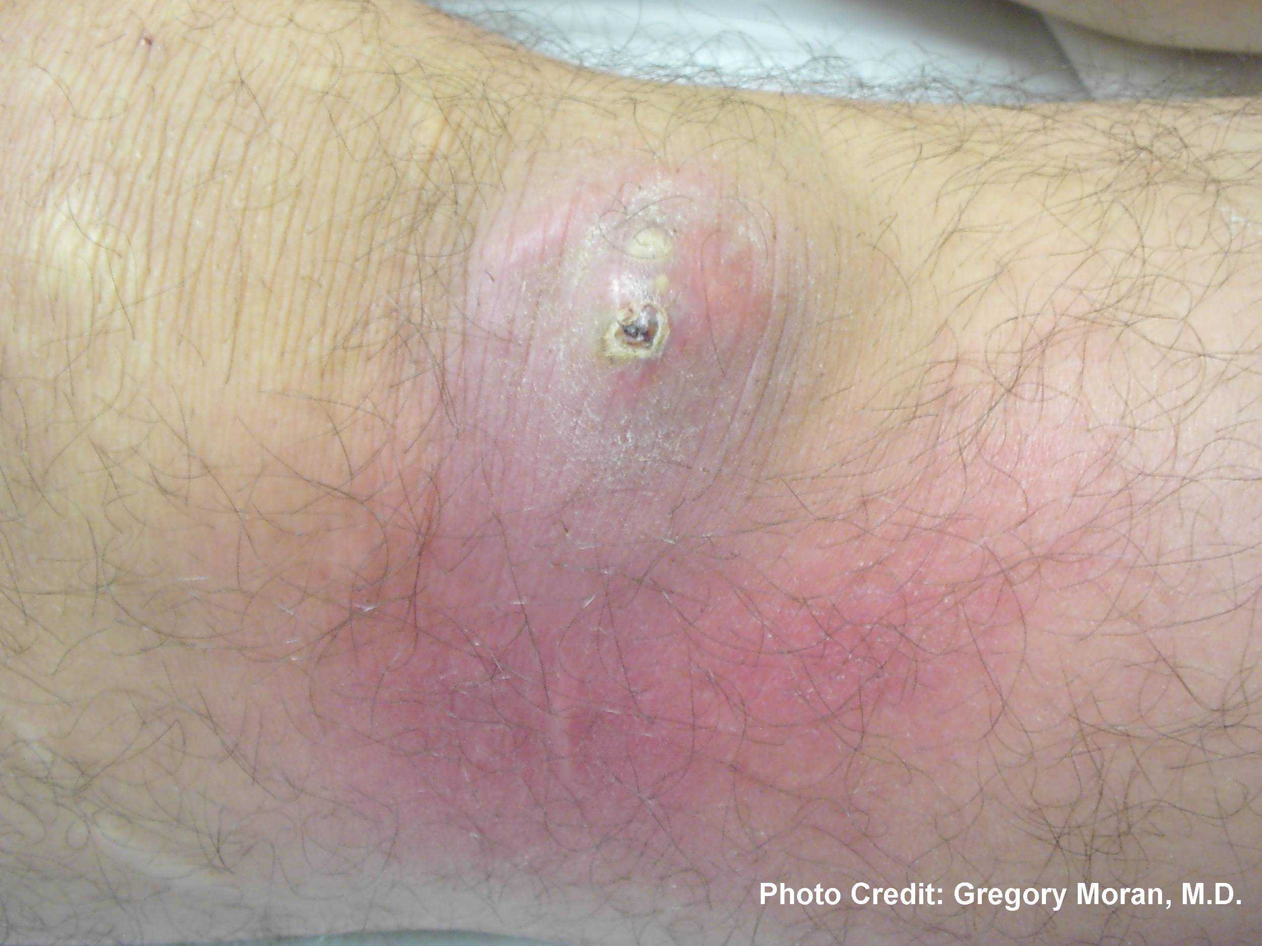 Cutaneous abscess caused by MRSA