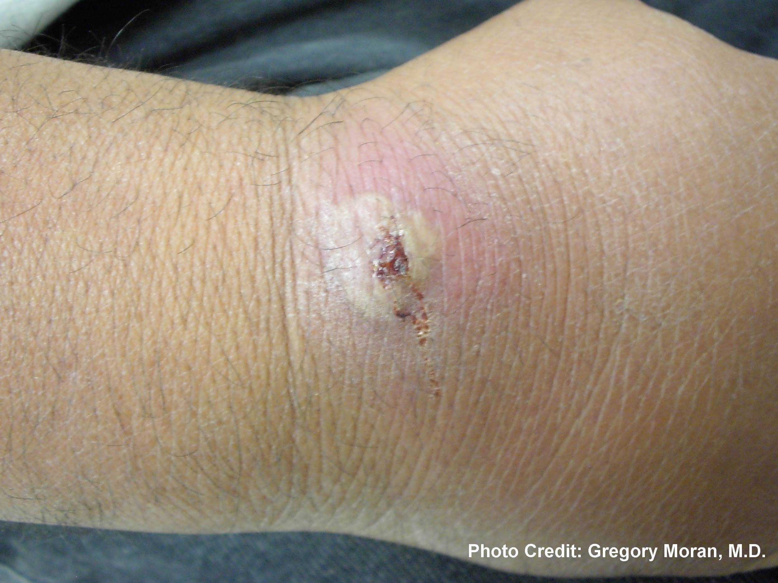 Cutaneous abscess caused by MRSA