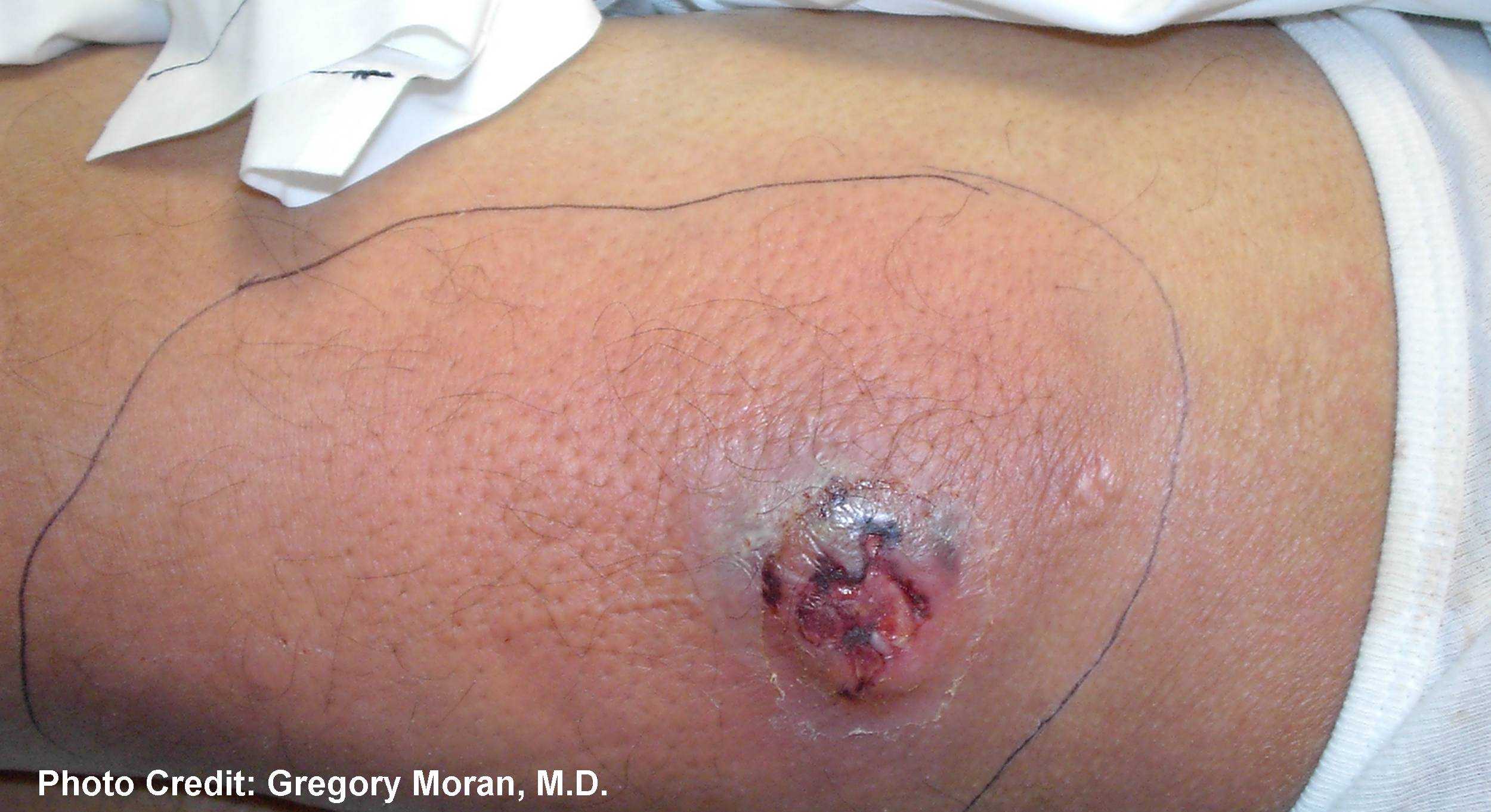 Cutaneous abscess caused by MRSA