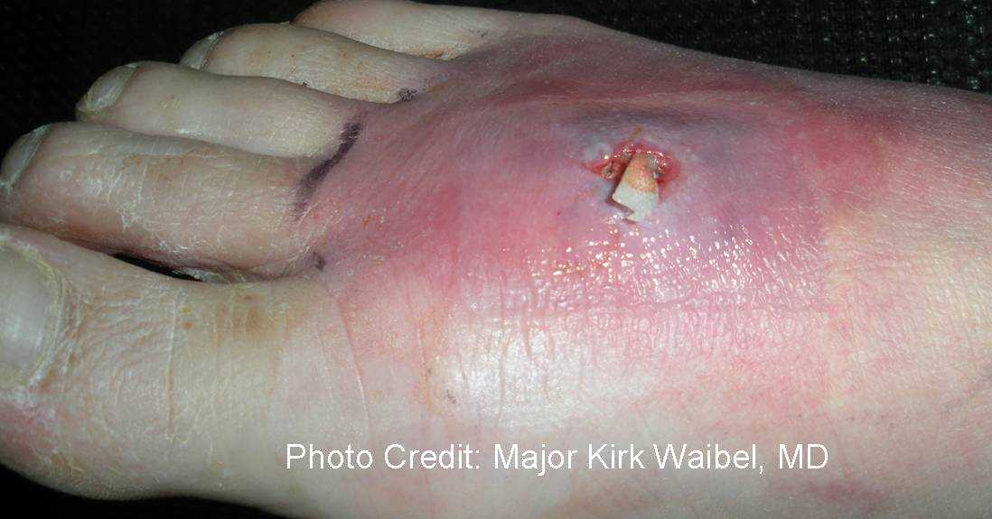 Photograph depicted a cutaneous abscess on the foot post packing (side view)