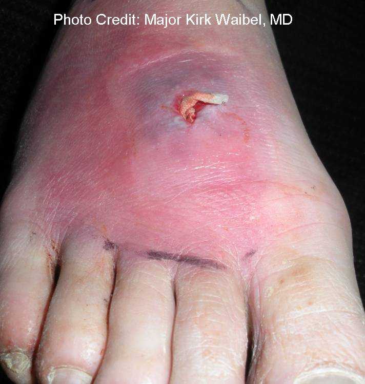 Cutaneous abscess on the foot post packing (front view)